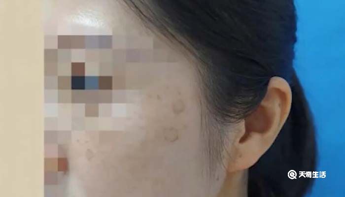 90后姑娘熬夜10年长出老年斑:没在凌晨2点之前睡过觉!