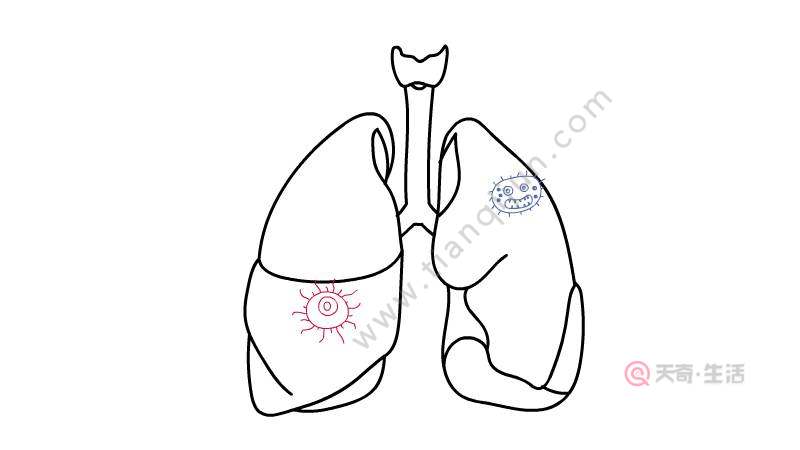 肺炎简笔画 肺炎简笔画步骤