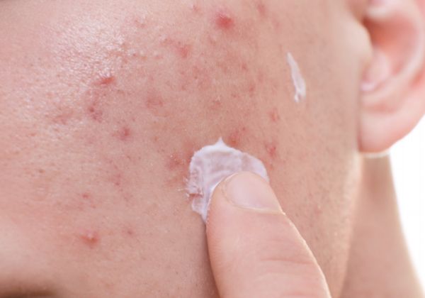 粉刺瘤的危害有哪些