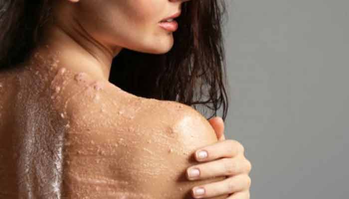 背部油性皮肤怎么改善